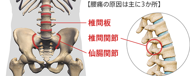 腰痛の原因は主に3か所